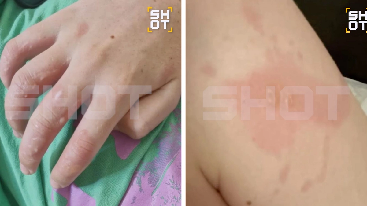 Школьница из России получила ожоги тела от мохито на отдыхе во Вьетнаме. Фото © SHOT
