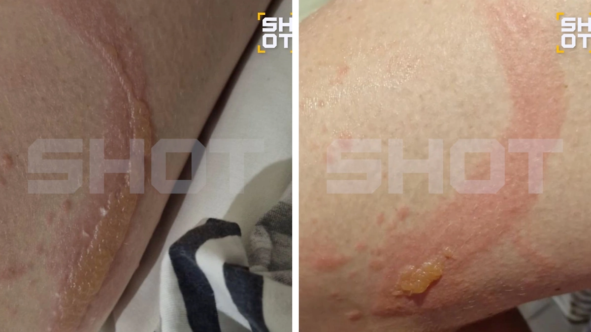 Школьница из России получила ожоги тела от мохито на отдыхе во Вьетнаме. Фото © SHOT