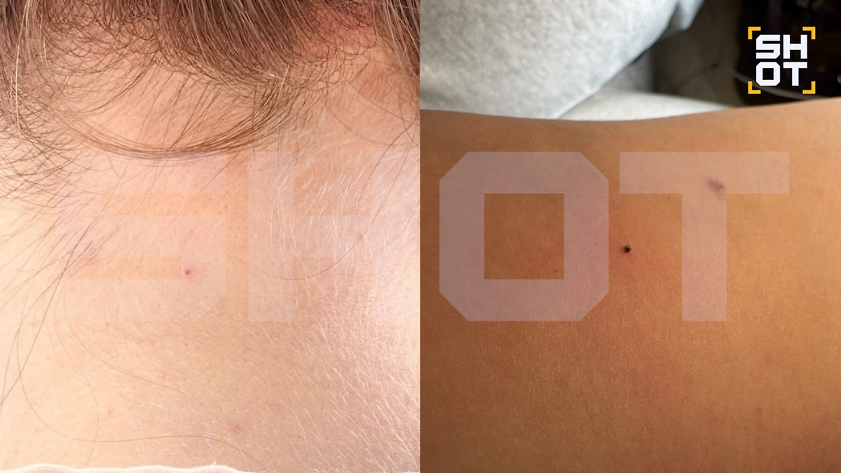 В России более 2 тысяч человек обратились к врачам после укусов наноклещей. Фото © Telegram / SHOT