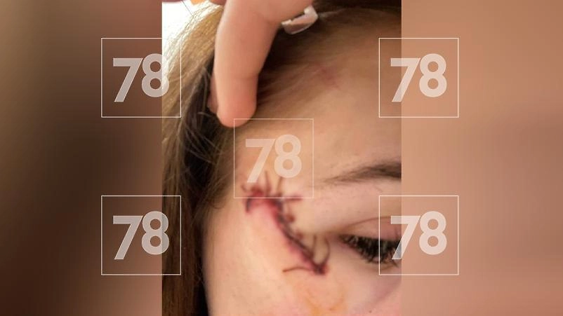 Травма девушки. Фото © Telegram / 78 | НОВОСТИ