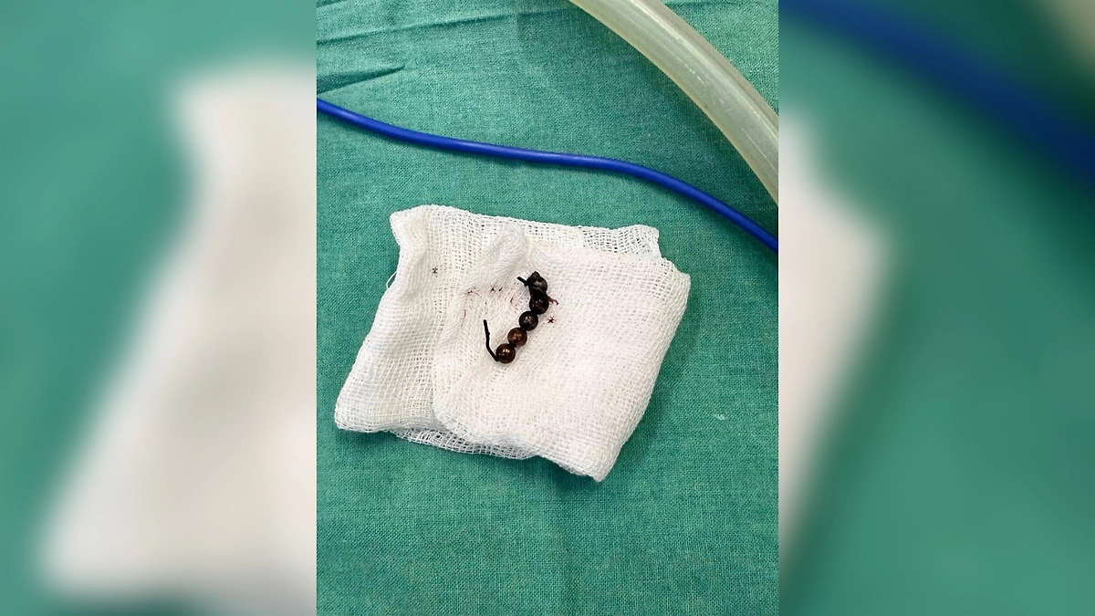 Магнитные шарики, извлечённые из кишечника подростка. Фото © Life.ru