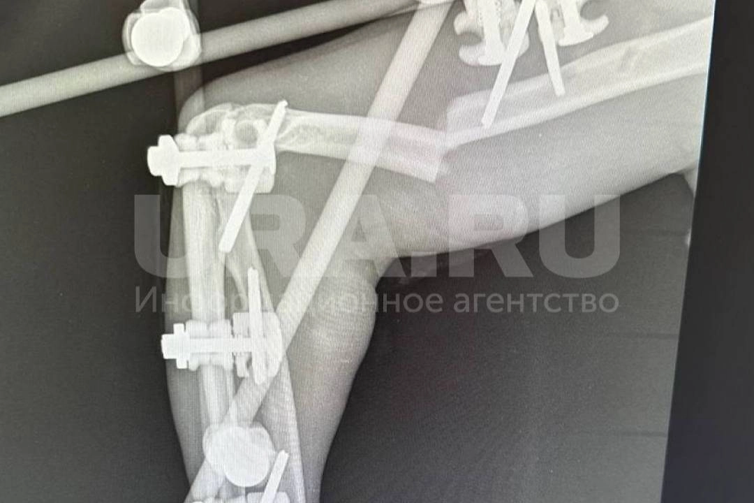 Хирурги пересобрали скелет рабочего. Фото © Telegram / URA.ru