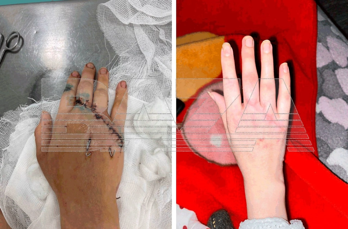 Кисть девушки не работает даже спустя год после происшествия. Фото © Telegram/ Baza