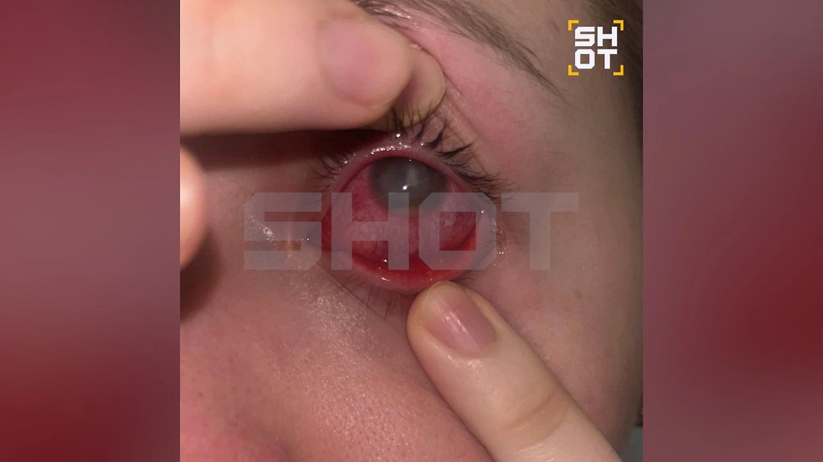 Глаз пострадавшей. Фото © SHOT