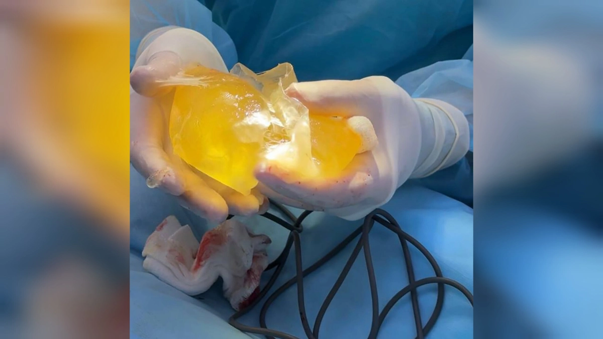 Силиконовая грудь взорвалась у блогерки из Уфы во время тренировки в зале. Обложка © Telegram / Mash