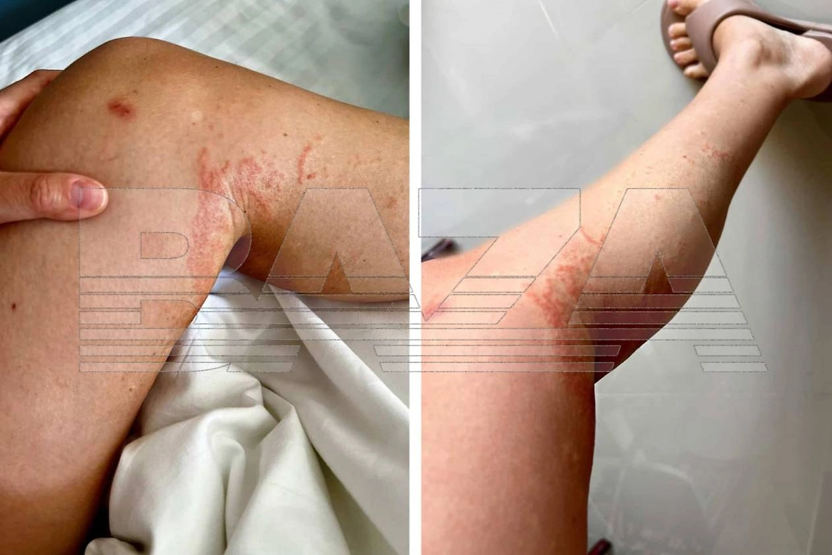 Российских туристов атакуют ядовитые медузы на побережье Пхукета. Фото © Telegram / Baza