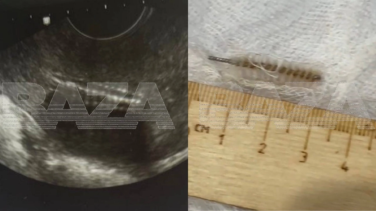 Гинеколог промолчала об отломившемся ёршике от щётки внутри пациентки. Фото © Telegram / Baza