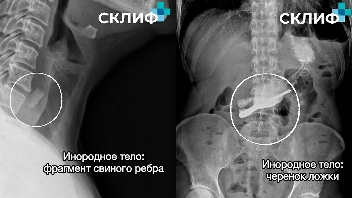 Извлечённые предметы из пациентов НИИ скорой помощи имени Н. В. Склифосовского. Фото © Telegram / Склиф