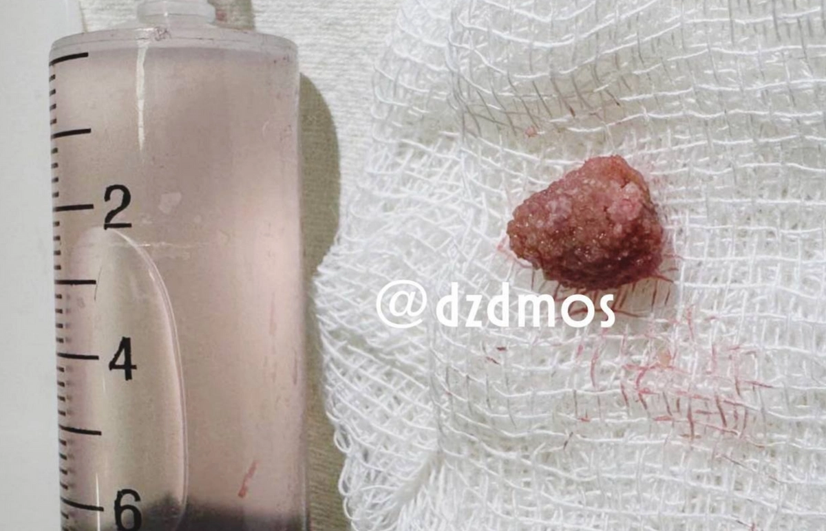 Изъятый из почек камень. Фото © Telegram / Московская медицина