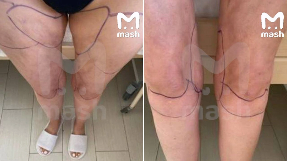 После липосакции ягодиц жительнице Краснодара грозит ампутация ног. Фото © Telegram / Mash