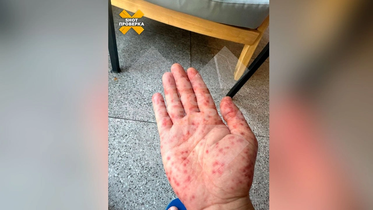 Последствия купания в пхукетском бассейне. Фото © SHOT ПРОВЕРКА