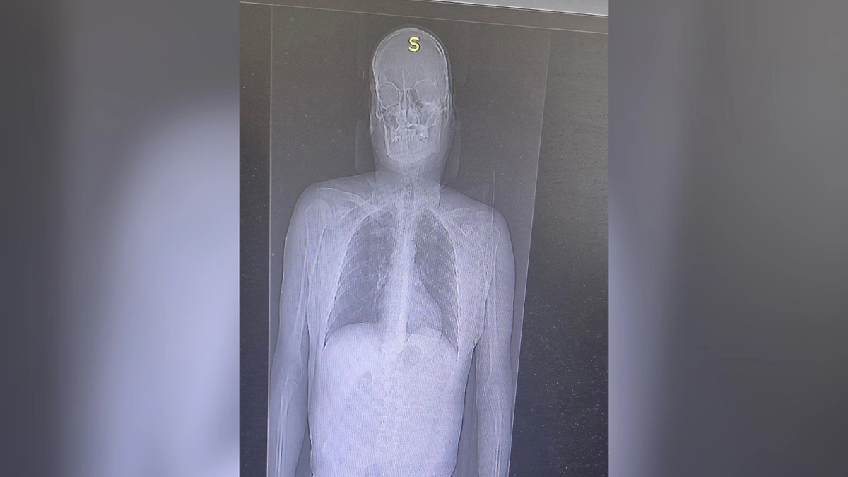 В Саратовской области мужчина попал в больницу после падения с «Эйфелевой башни». Фото © Telegram / ГУЗ СО «Балаковская городская клиническая больница»