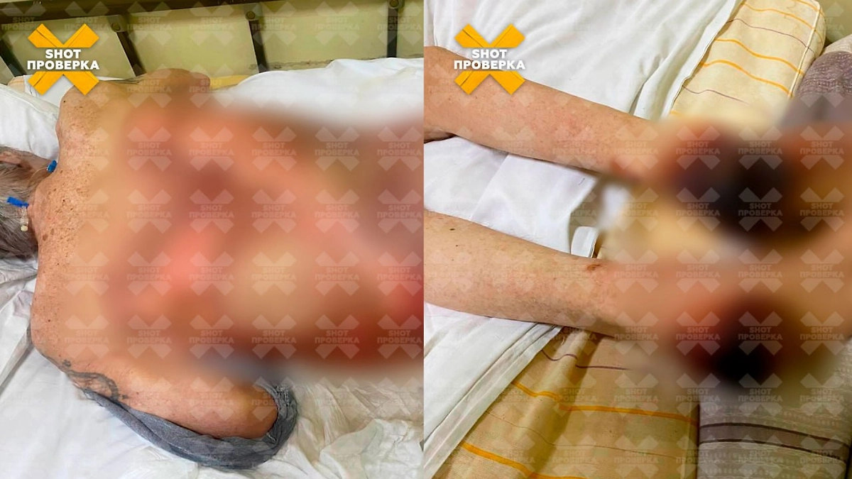 Ожоги, полученные жителями Обнинска из-за слишком горячей воды в домах. Коллаж @ SHOT ПРОВЕРКА