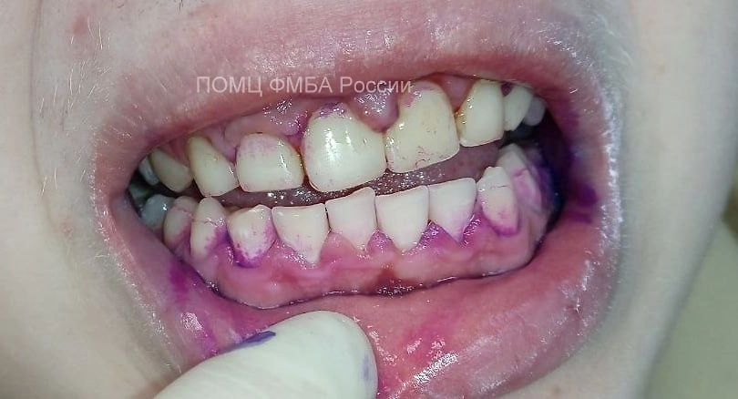 Зубы любителя энергетиков из Нижнего Новгорода до обращения к врачам. Фото @ Telegram / «Бокал Прессека»