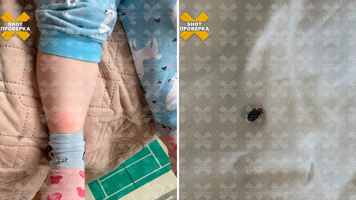 Укусы от клопов. Фото © Telegram / SHOT ПРОВЕРКА