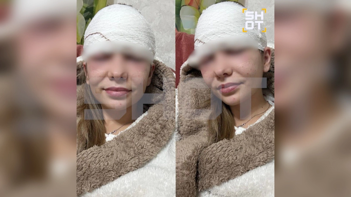 Россиянке потребовалось операция после того, как она выдавила прыщ на лбу. Фото © SHOT