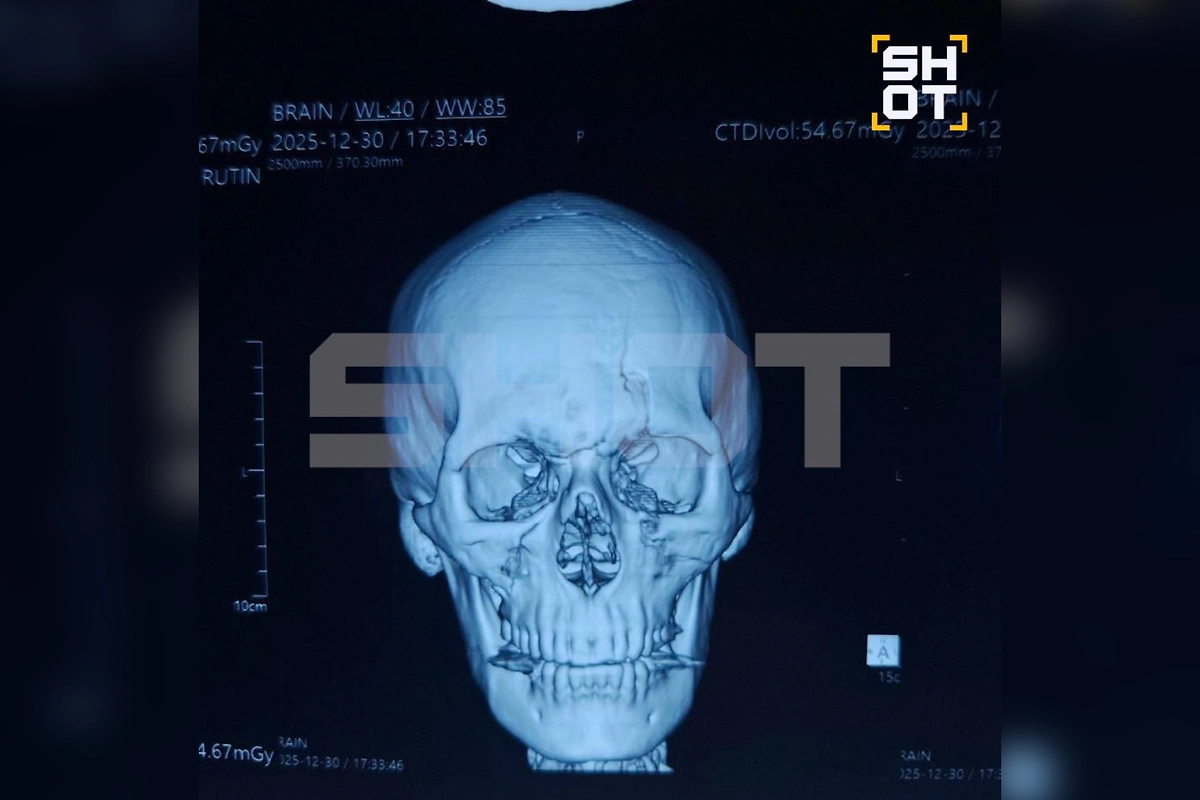 Россиянин попал в страшное ДТП на Бали, у него паралич позвоночника и жуткие переломы. Фото © SHOT