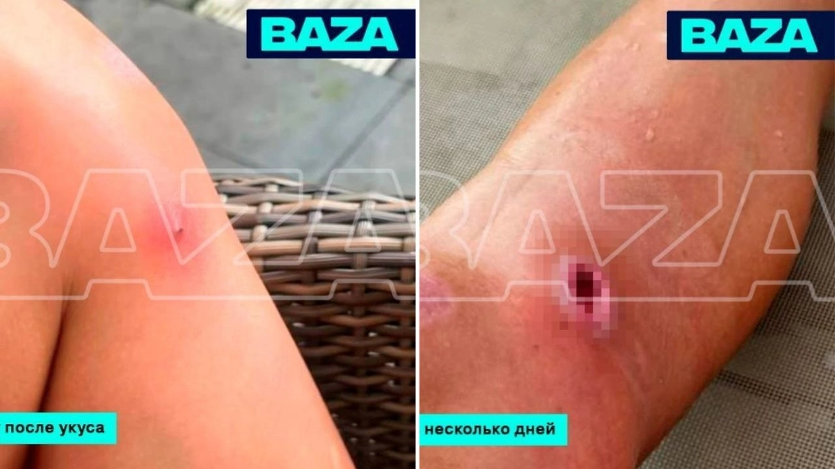 Укус комара на Бали обернулся для россиянки операцией и шрамом. Фото © Telegram / Baza
