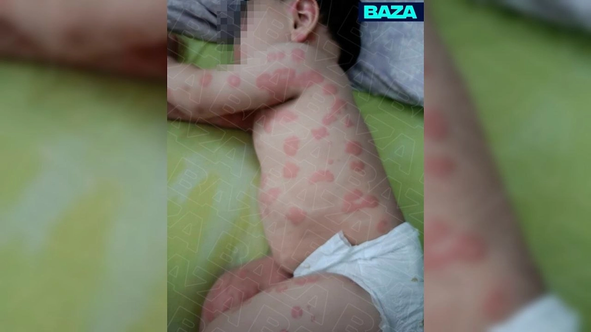 Младенец из России покрылся пятнами после укуса бездомного кота в Турции. Фото © Telegram / BAZA