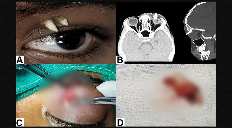 У 16-летнего подростка в Индии под верхним веком вырос клык. Фото © Ophthalmology