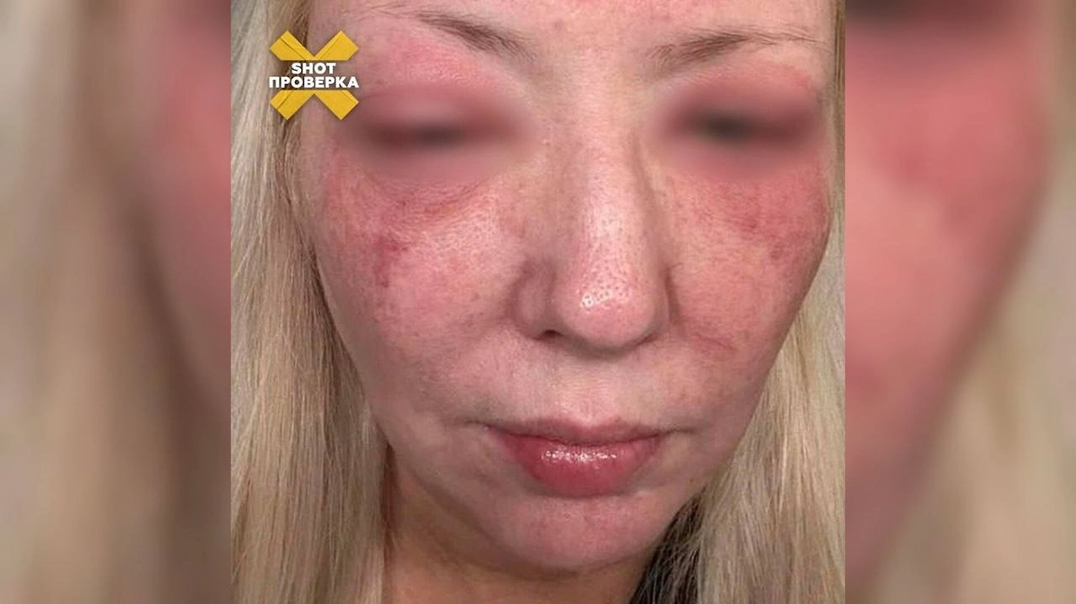 Последствия нового бьюти-тренда с волюфилином, который набирает популярность в России. Фото © Telegram / SHOT ПРОВЕРКА