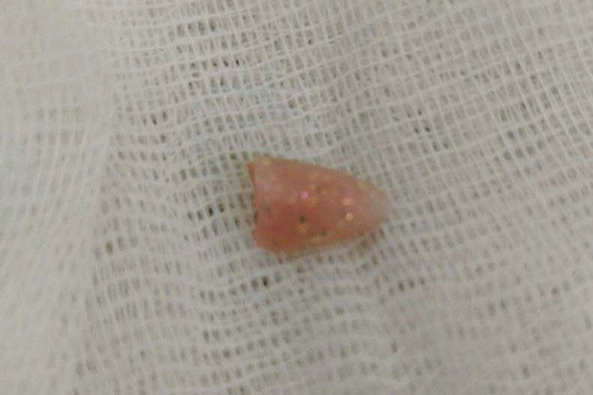 Тот самый ноготь. Фото © VK / ЧОДКБ