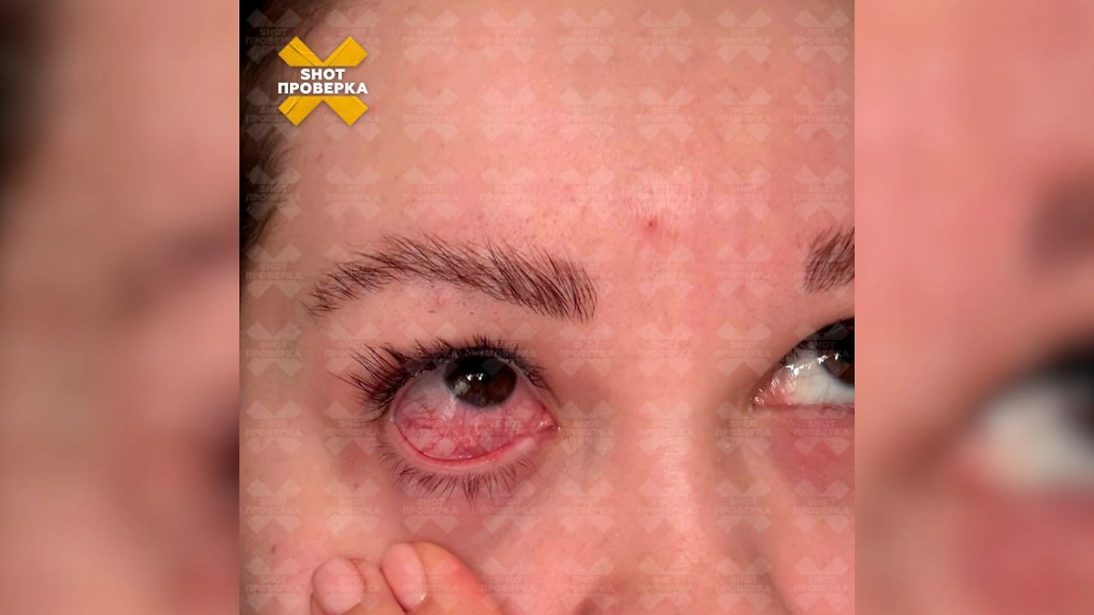 Последствия наращивания ресниц в одном из салонов красоты в Москве. Фото © SHOT ПРОВЕРКА