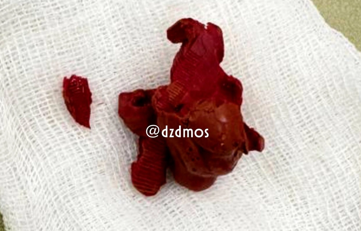 Московские хирурги достали из мочевого пузыря подростка комок пластилина. Фото © Telegram / Московская медицина