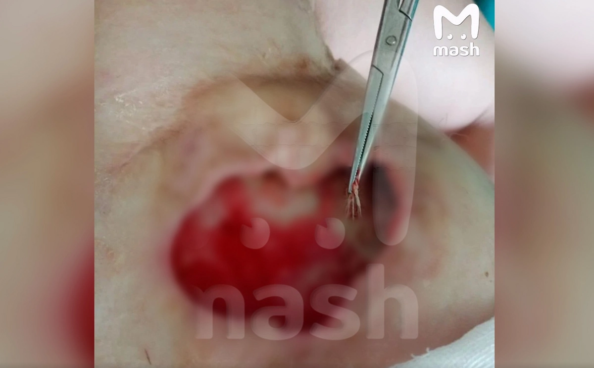 Хирург забыл салфетку в груди у пациентки. Фото © Telegram / Mash