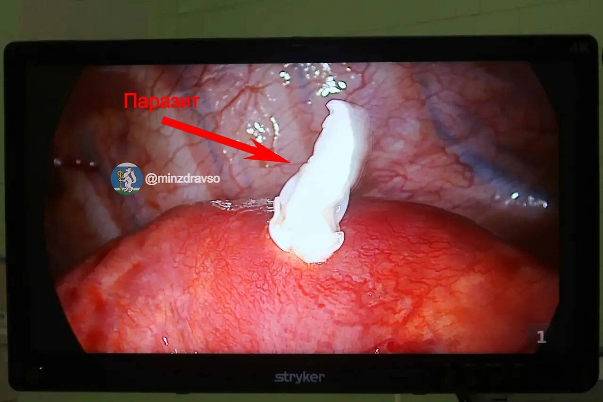 Свердловские хирурги удалили личинок ленточного червя из печени пациентки через проколы. Фото © Пресс-служба Минздрава Свердловской области