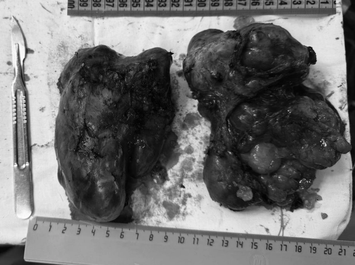 Пенсионерка едва не умерла от опухоли на шее. Фото © Telegram / Наша РКБ