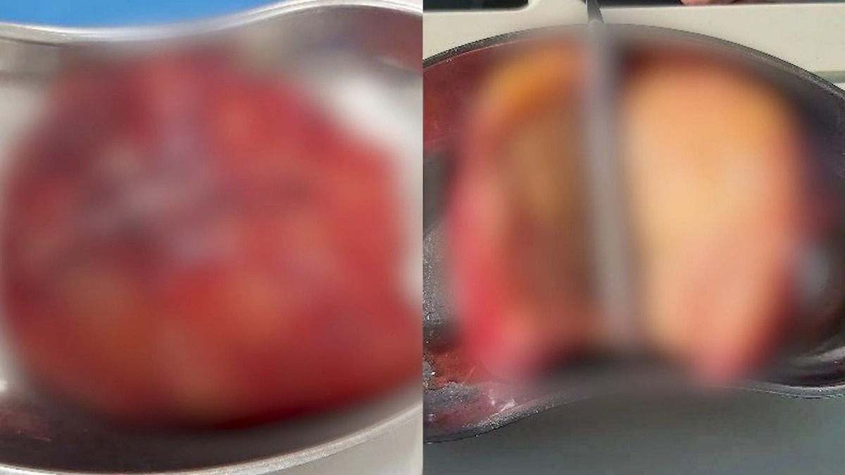 Во Владивостоке 18-летнему пациенту удалили почти килограммовую опухоль надпочечника. Фото © Telegram / Минздрав Приморья