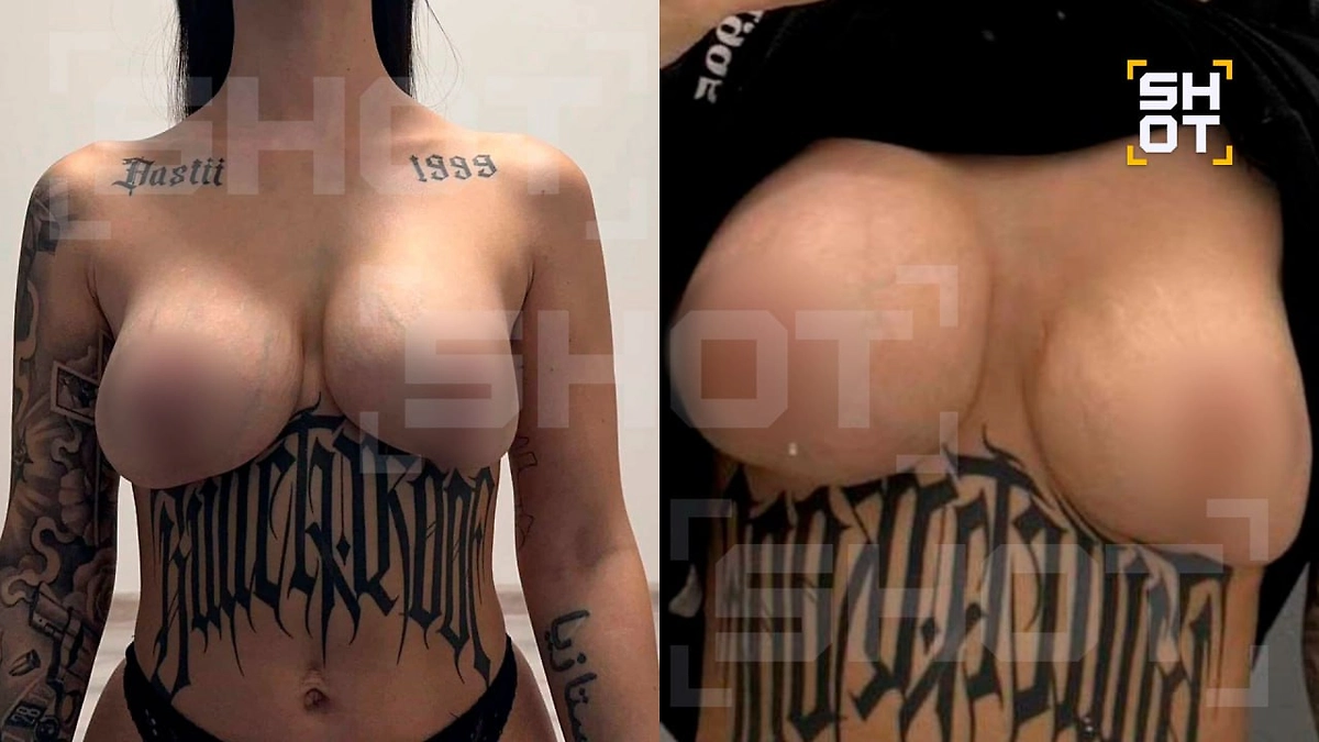 Последствия пластической операции у хирурга Авдеева. Фото © Telegram/ SHOT