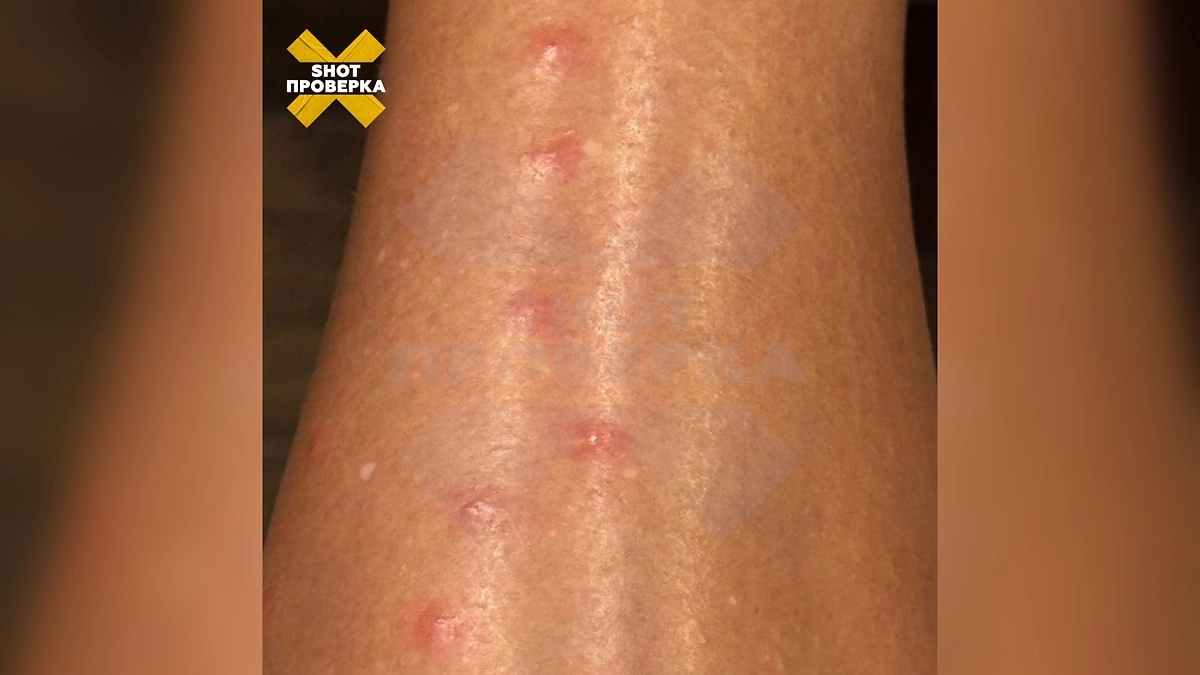 Последствия укусов песчаных мух. Фото © Telegram / SHOT ПРОВЕРКА