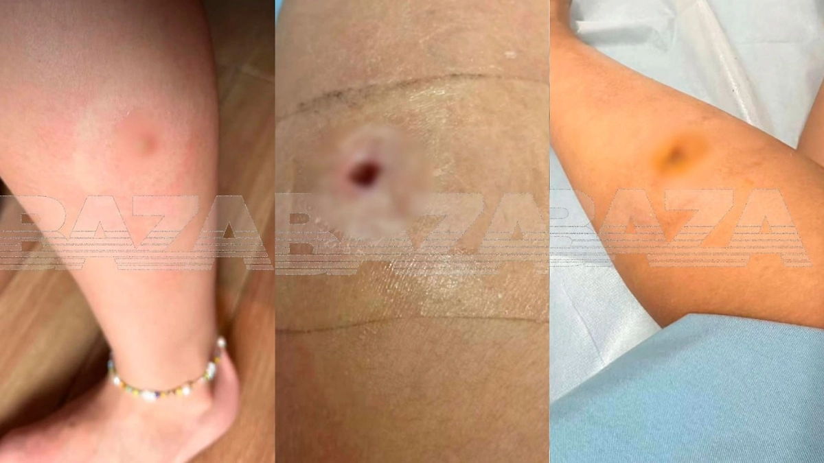 Укус, полученный россиянкой от жука-плавунца на Бали. Коллаж © ТАСС / imago images / McPHOTO / R. Mueller