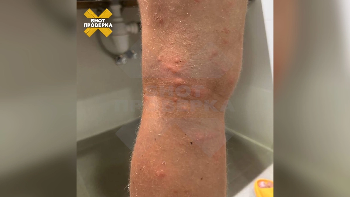 Последствия укусов песчаных мух. Фото © Telegram / SHOT ПРОВЕРКА
