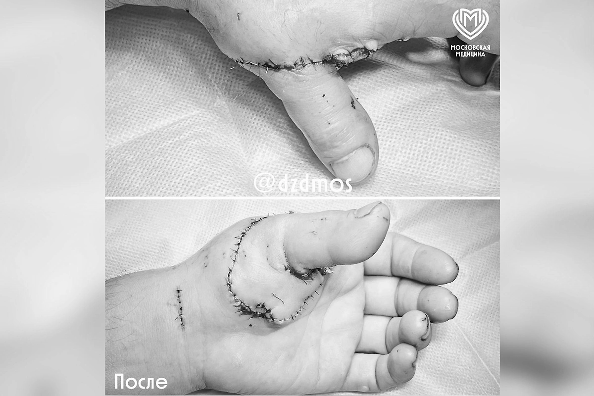 Пришитый палец пациента. Фото © Telegram / Московская медицина