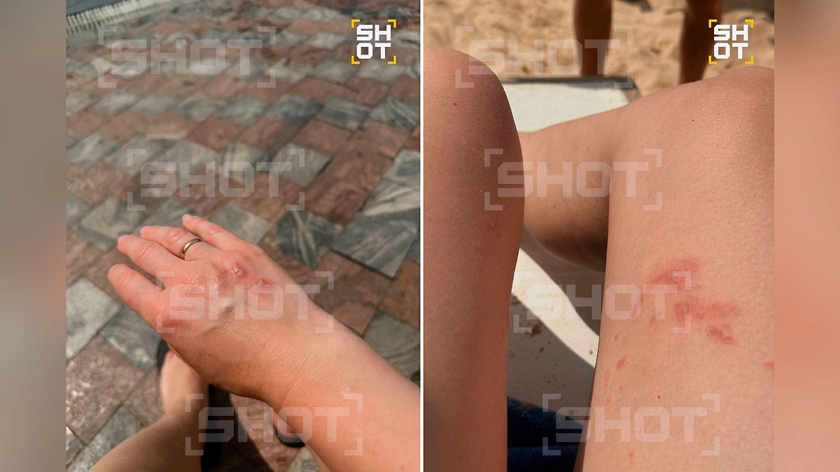 После укусов жуков остаются страшные ожоги. Фото © Telegram / SHOT