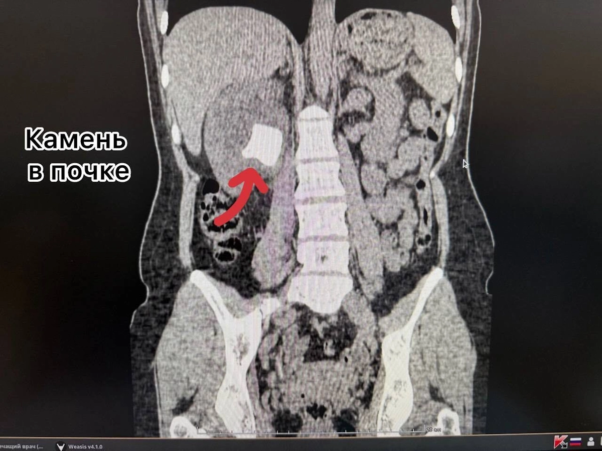 Рентген женщины с вросшим стентом во Владивостоке. Обложка © Telegram / Тысячекоечная больница г. Владивосток