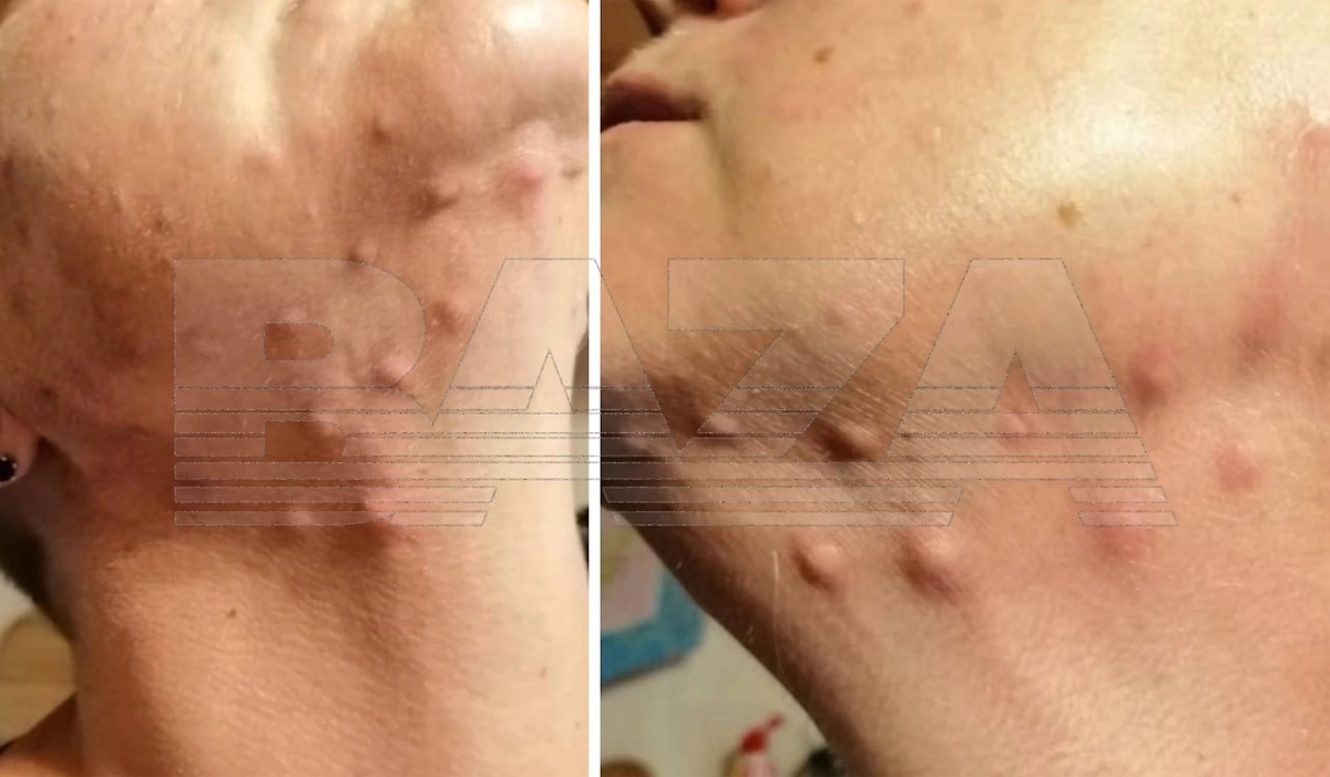 Москвичка попала под нож хирурга после уколов золота для омоложения. Фото © Telegram-канал Baza.