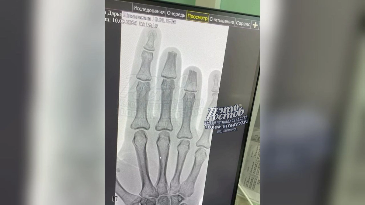 В Шахтах девушка лишилась двух пальцев из-за падения стола в кафе. Видео © Telegram-канал «Это Ростов Новости»