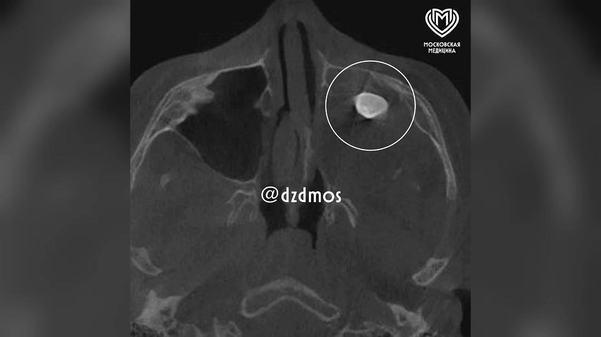 Московские врачи удалили подростку зуб, выросший в носу. Фото © Telegram / Московская медицина