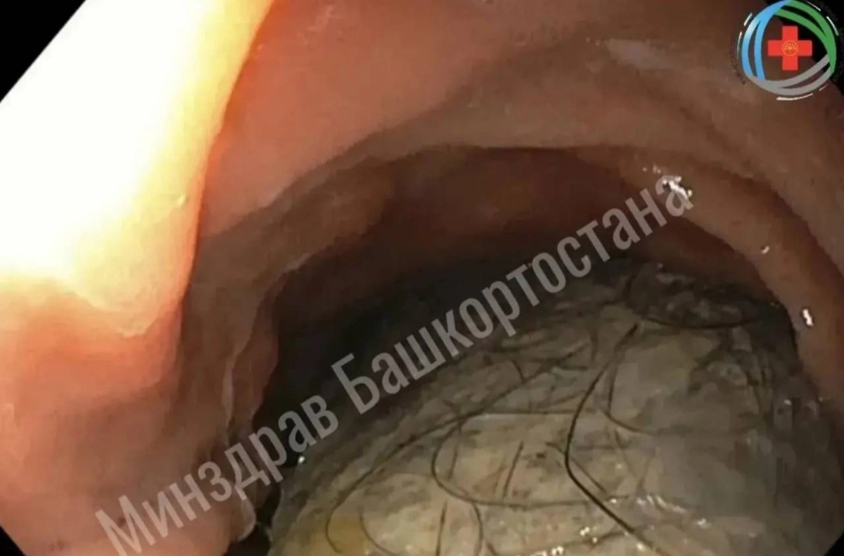 В Башкирии врачи достали из желудка девочки-подростка комок волос. Фото © VK /Айрат Рахматуллин