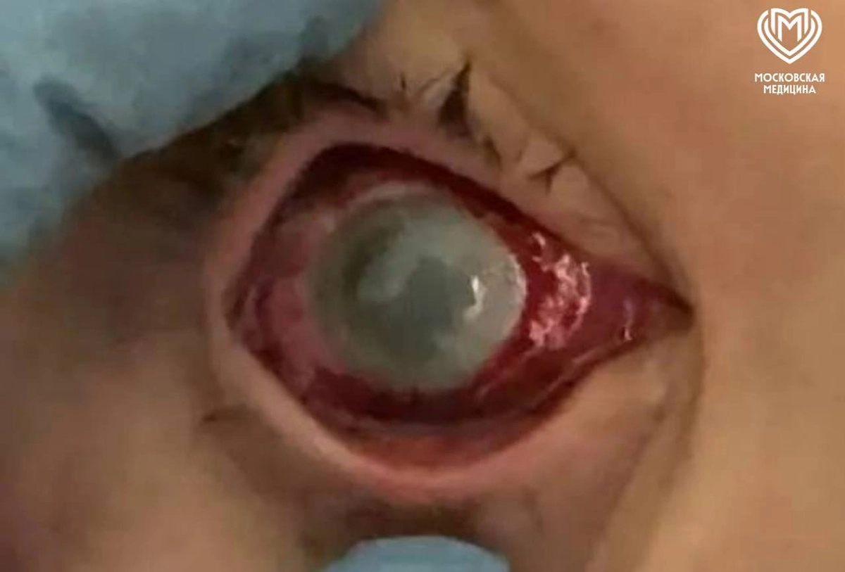 В Москве подростки попали в больницу с ожогами глаз из-за опыта из сети. Фото © Telegram / Московская медицина