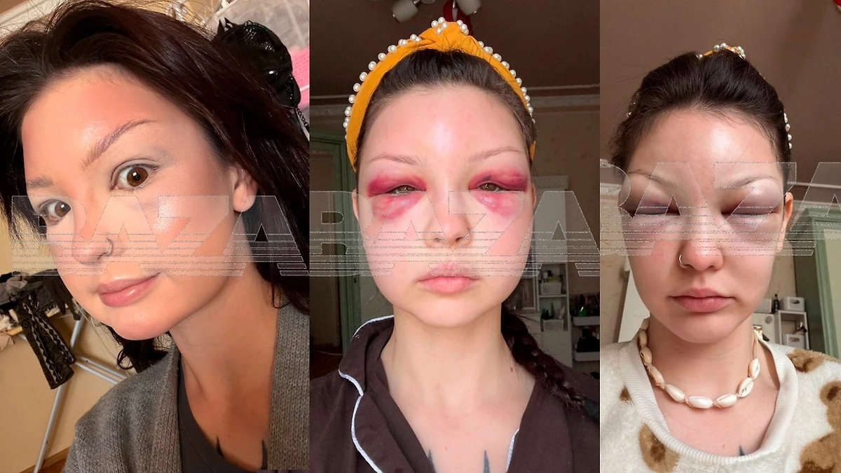 Москвичка едва не лишилась зрения после неудачной инъекции ботокса и самолечения. Фото © Telegram / Baza