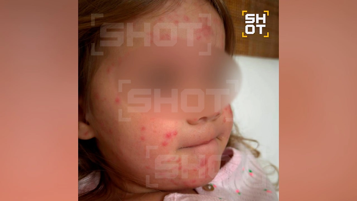 Трёхлетняя девочка заразилась кожной инфекцией после укуса комара и купания на Бали. Фото © Telegram / SHOT