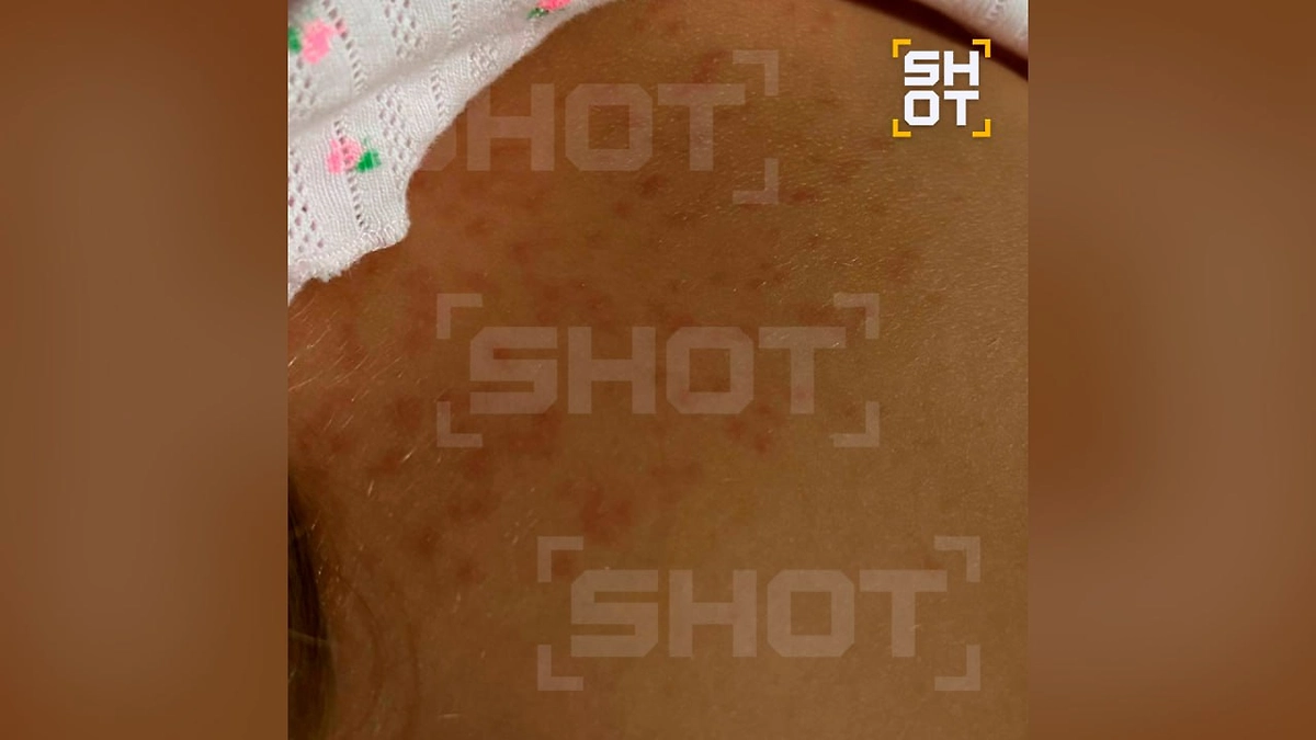 Трёхлетняя девочка заразилась кожной инфекцией после укуса комара и купания на Бали. Фото © Telegram / SHOT