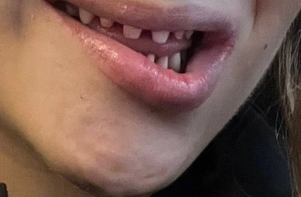 Россиянка пожаловалась на осложнения после установки виниров в Турции. Фото © Telegram/ BAZA