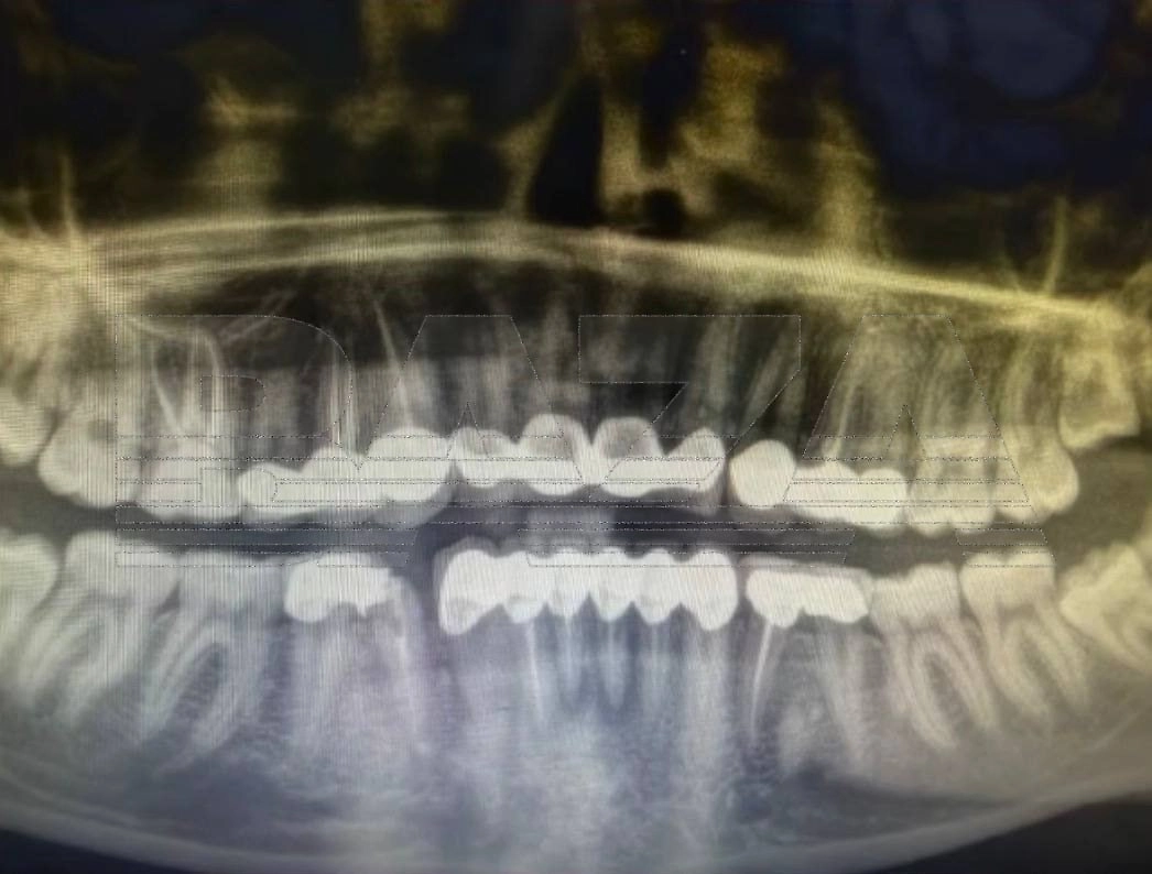 Россиянка пожаловалась на осложнения после установки виниров в Турции. Фото © Telegram/ BAZA