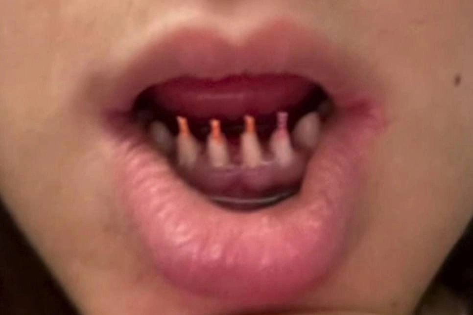 Россиянка пожаловалась на осложнения после установки виниров в Турции. Фото © Telegram/ BAZA